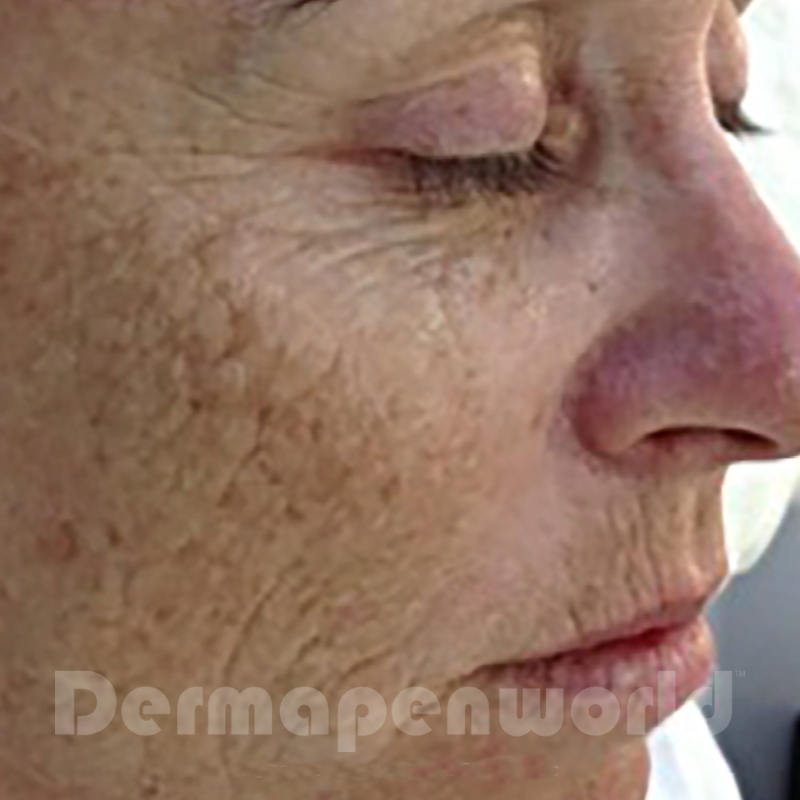 microneedling