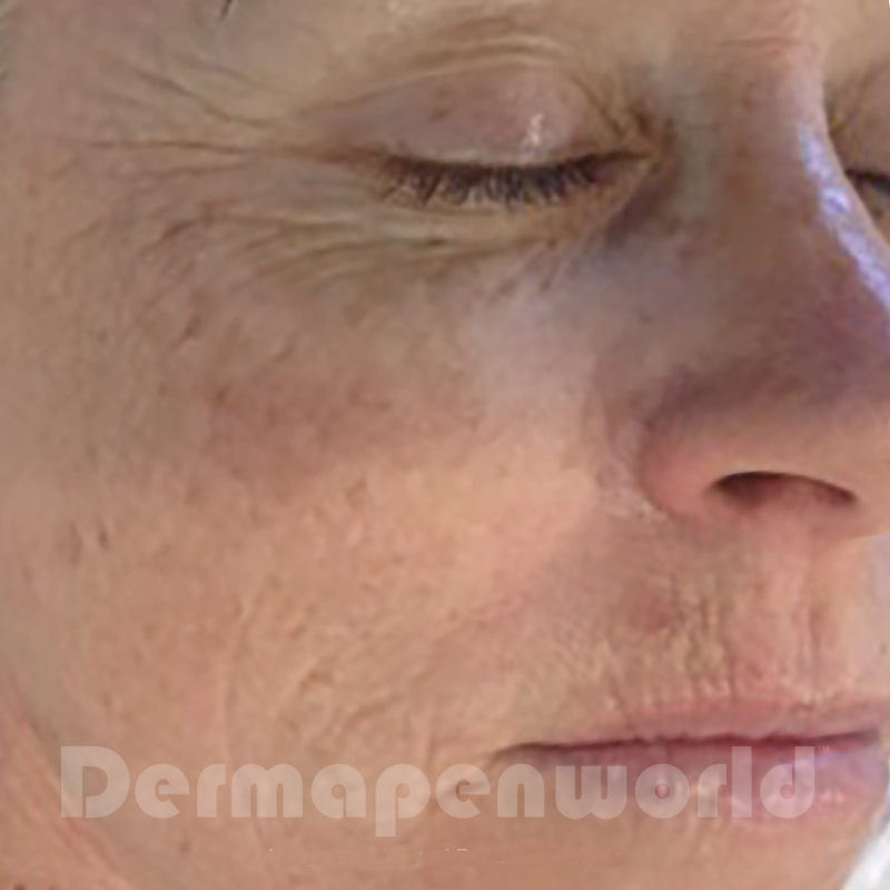 dermapen behandling