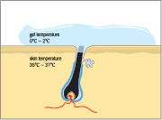 Epilia diodlaser