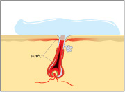 laser behandling