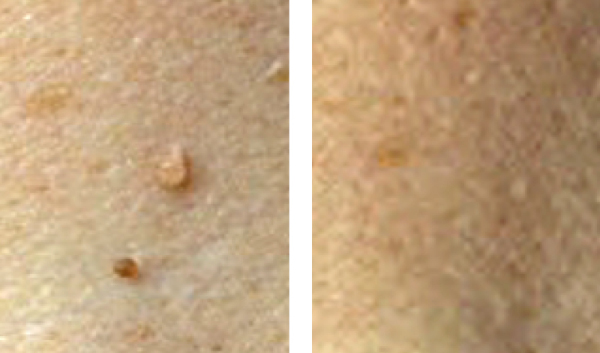 skin tags