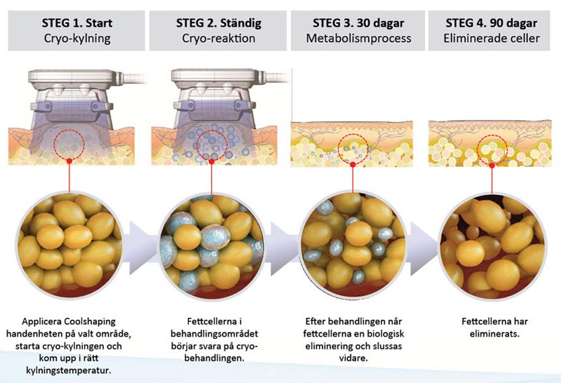 coolsculpting med cryolipolys